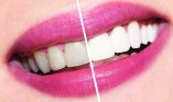 teeth white before&after