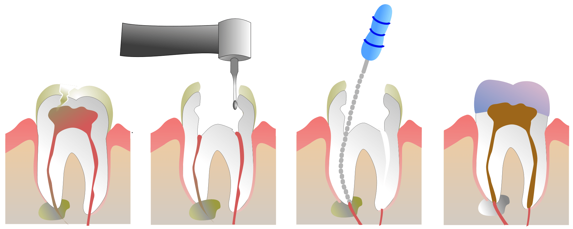 2000px-root_canal_illustr